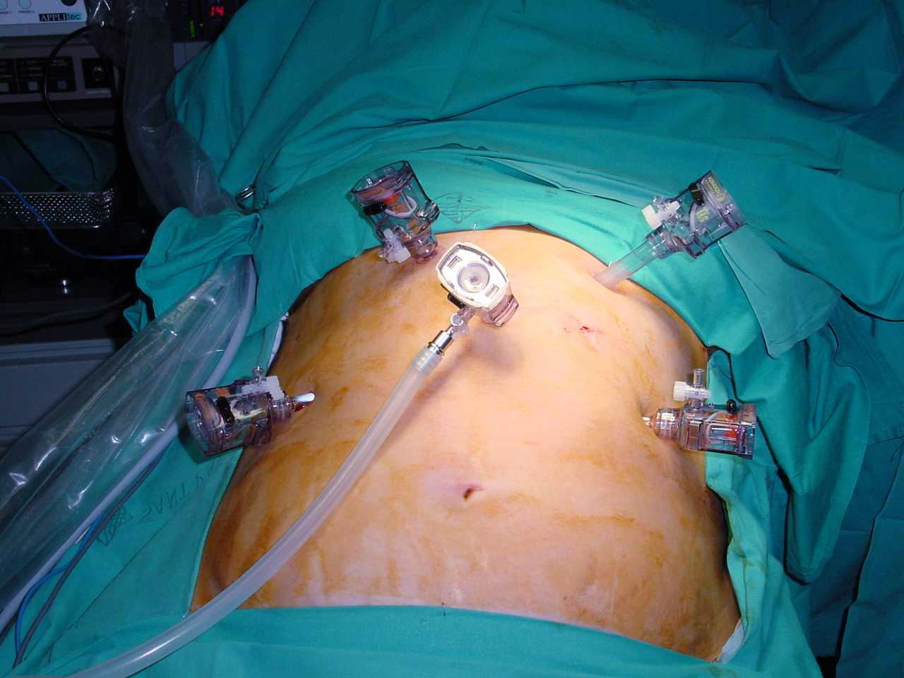 Cirugía Pared Abdominal